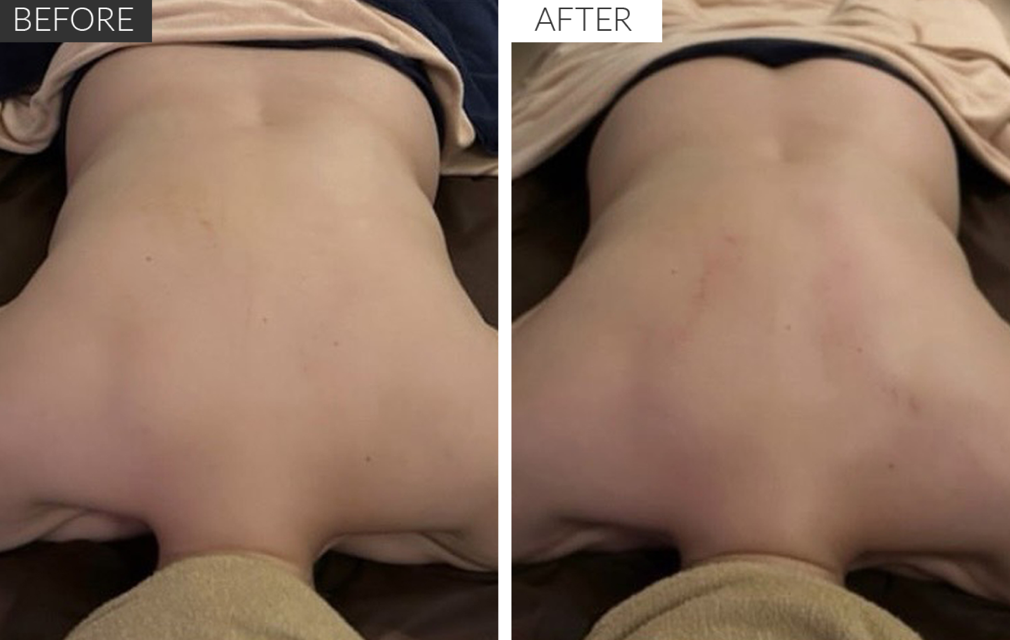 BACK SCULPTING ビフォアアフター